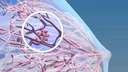 O nouă moleculă pentru tratamentul cancerului la sân va putea fi utilizată în anumite ţări