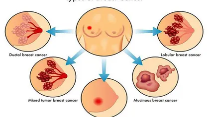 Răspândirea cancerului de sân în alte organe poate fi stopată. Ce spun specialiştii