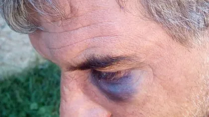 Un bărbat a fost bătut crunt de primarul şi viceprimarul unei comune din Braşov. Motivul, HALUCINANT FOTO