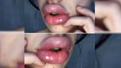 ŞOCANT! Cum a ajuns această tânără să fie mutilată pe viaţă după ce şi-a mărit buzele FOTO