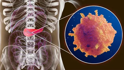 Descoperire uimitoare: tratarea cancerului pancreatic în numai 14 zile