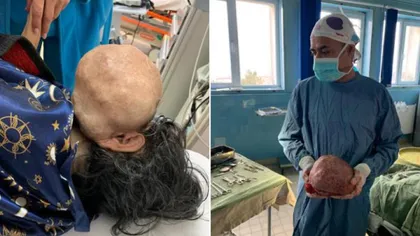 Medicii din Caransebeş au extirpat de pe faţa unei femei o tumoră gigant de 3 kilograme