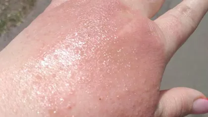 IMAGINI ŞOCANTE. O femeie din Brăila s-a ales cu arsuri grave pe mâini după ce a utilizat dezinfectant la un supermarket FOTO