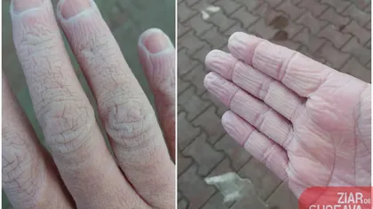 Impresionant! Cum arată mâinile unui cadru medical după 12 ore de muncă. Trebuie să poarte trei perechi de mănuşi una peste alta