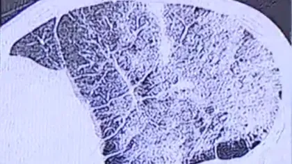Cum arată plămânii afectaţi de coronavirus. Leziunile pulmonare apărute în urma infectării sunt ireversibile