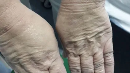 Cum arată mâinile medicilor după o zi în combinezoanele ANTI-COVID. IMAGINI ŞOCANTE