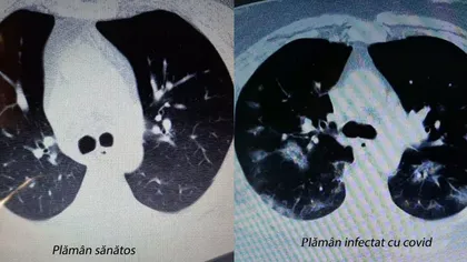 Medic radiolog: Nu există nicio diferenţă între plămânii unui pacient cu pneumonie şi cei ai unui pacient COVID