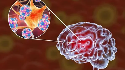 STUDIU Durerile de cap, starea de confuzie, delirul, rezultatul unei invazii a coronavirusului la nivelul creierului