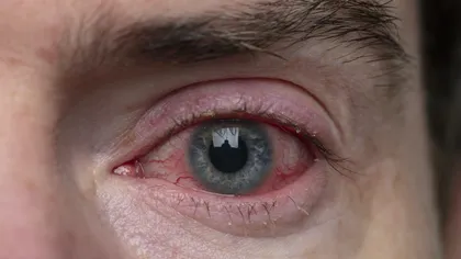Ochii roşii pot fi un simptom al coronavirusului. În Canada, pacienţii cu conjunctivită sunt trataţi ca potenţiali purtători de Covid