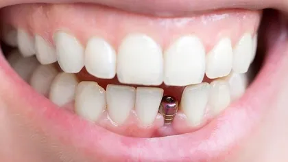 5 curiozităţi despre implanturile dentare