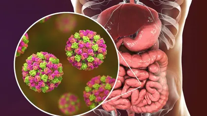 O nouă epidemie face ravagii în România. 140 de cazuri de Norovirus raportate în Râșnov