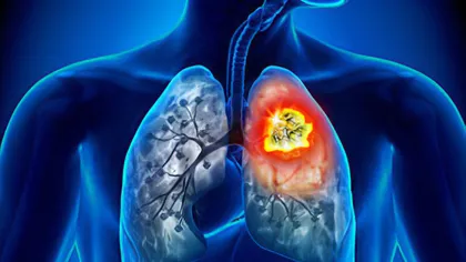 Primul simptom în cancerul pulmonar. Care sunt semnele care ar trebui să te alerteze