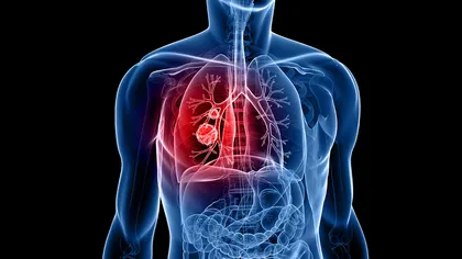 Utilizarea testării biomarkerilor în cancerul pulmonar poate salva viața pacienților