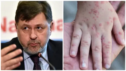 EXCLUSIV | Alexandru Rafila, avertisment despre infecţiile cu variola maimuţei. 