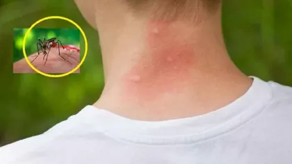 Cele mai simple metode ca să scapi de țânțari. Cât de periculoase sunt muşcăturile şi cum se tratează