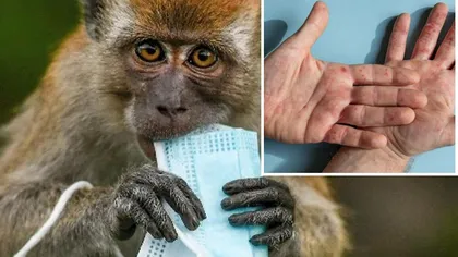Un nou caz de variola maimuţei a fost confirmat în România. Bilanţul a ajuns la 42 de persoane infectate