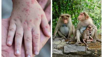Român din Marea Britanie infectat cu variola maimuței. Atât el, cât și prietena lui sunt internați la spital