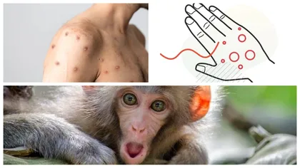 Primul caz de variola maimuţei în România. Anunţ oficial de la Ministerul Sănătăţii