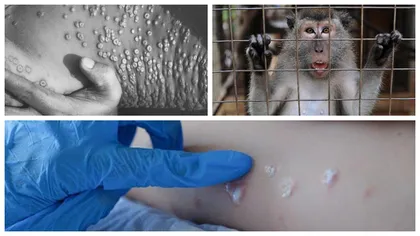 Noi cazuri de variola maimuţei în România. Este vorba despre doi bărbaţi din Bucureşti