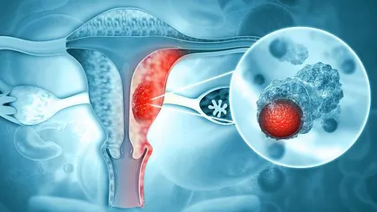 Trei românce mor de cancer ovarian în fiecare zi. Depistată în stadii incipiente, boala poate fi vindecată în 90% din cazuri