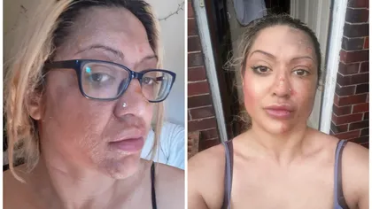 Un truc viral pe TikTok i-a ars fața unei femei. Victima trage un semnal de alarmă: 