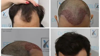 Schimbarea majoră poate veni cu ajutorul implantului de păr realizat prin tehnica Q FUE
