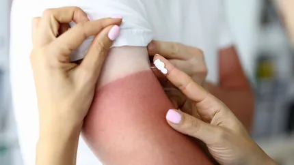 Cât de periculoase sunt arsurile solare și cum le putem preveni. Dezvăluirile făcute de medicul dermatolog Iulia Roșu