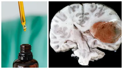 Revoluție în medicină! Un bărbat cu cancer cerebral s-a vindecat datorită unui medicament-minune