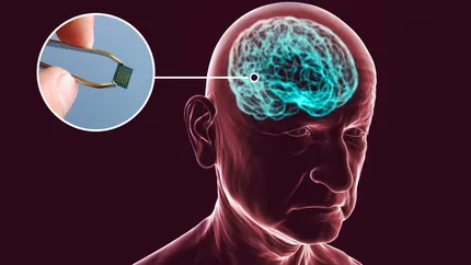 Un cip cerebral revoluționar decodifică monologurile interioare ale oamenilor în timp real