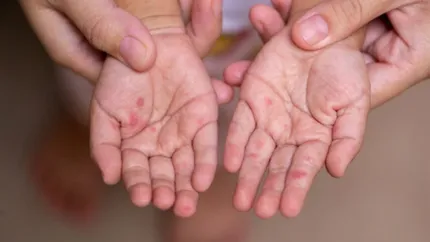 România, fruntașă la nivel european. Cele mai multe cazuri de rujeolă în 2025