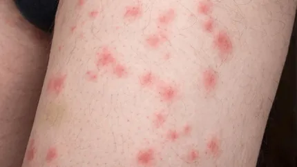 Tânără de 24 de ani, acoperită de mușcături de ploșnițe, după o noapte la cușetă pe ruta București–Sighet