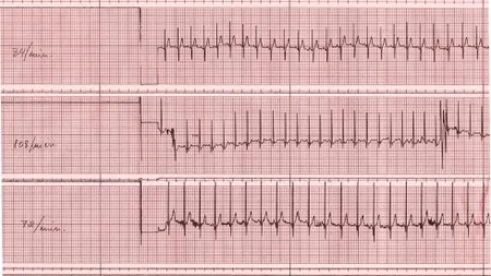 România, a treia ţară din lume la decesele cauzate de afecţiunile cardiovasculare