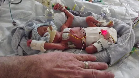 Un bebeluş cât palma: A supravieţuit, deşi s-a născut la doar 5 luni şi 500 de grame FOTO