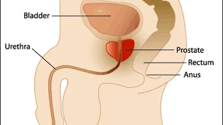 Veste bună pentru bărbaţi: Tratament revoluţionar al cancerului de prostată VIDEO