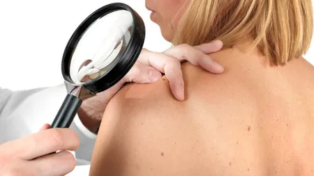 Testări gratuite pentru depistarea melanomului