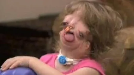 O fetiţă s-a născut fără faţă. Medicii au operat-o de 14 ori, dar degeaba VIDEO