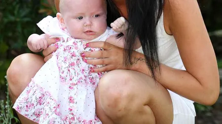 Fetiţa născută cu o tumoare de mărimea unui pepene pe faţă
