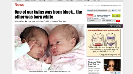 Două gemene s-au născut una albă şi cealaltă neagră FOTO