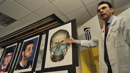 INCREDIBIL: Cum arată un bărbat care a primit cel mai complex transplant facial din lume FOTO