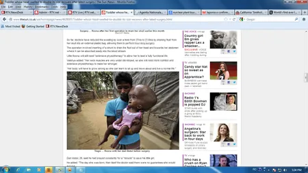 Fetiţa din India cu cap de extraterestru a fost operată. Vezi cum arată acum!  GALERIE FOTO