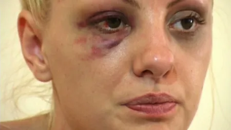 Alexandra Stan a ieşit din spital. De câte zile de îngrijiri medicale mai are nevoie după bătaie