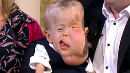 Un băieţel de 2 ani i-a uimit pe medici cu boala lui extrem de rară. Nu se ştie încă de ce suferă