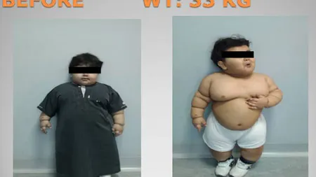Povestea băieţelului care la DOI ANI avea o greutate de 33 de KILOGRAME. Vezi cum a fost salvat FOTO