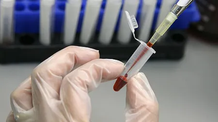 Un test de sânge distinge nodulii pulmonari benigni de cei canceroşi