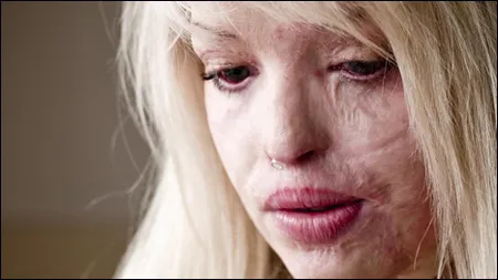 Femeia cu faţa distrusă cu acid sulfuric a născut. Primele imagini