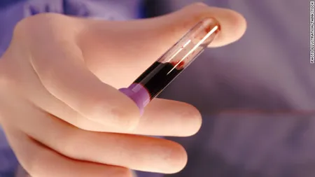 Test de sânge REVOLUŢIONAR. Ar putea detecta sindromul Down în timpul sarcinii