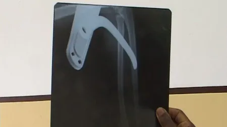 Accident tragic: Un copil, mutilat pe viaţă după ce i s-a înfipt o clanţă într-un braţ VIDEO