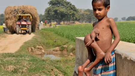 Un băiat din India are PATRU MÂINI şi PATRU PICIOARE. Oamenii îl cred ZEU VIDEO