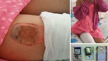 Imagini de coşmar: Un smartphone a explodat în buzunarul unei fetiţe de 7 ani FOTO