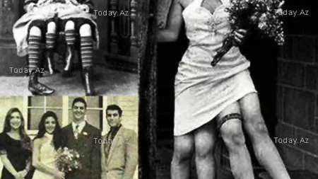 Povestea femeii cu PATRU PICIOARE care a uimit lumea acum 100 de ani: Cum a reuşit să nască de CINCI ORI FOTO